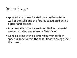 Sellar Stage
• sphenoidal mucosa located only on the anterior
wall of the sella and the floor is coagulated with a
bipolar and excised.
• Anatomical landmarks are identified in the aerial
panoramic view and mimic a “fetal face”.
• Gentle drilling with a diamond burr under low
speed is done to thin the sellar floor to an egg shell
thickness.
 