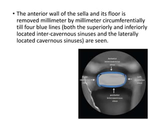 • The anterior wall of the sella and its floor is
removed millimeter by millimeter circumferentially
till four blue lines (both the superiorly and inferiorly
located inter-cavernous sinuses and the laterally
located cavernous sinuses) are seen.
 