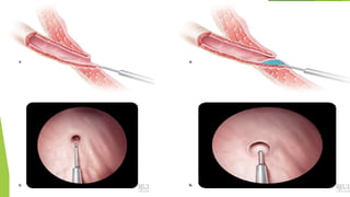 Endoscopic injection in VUR | PPTX