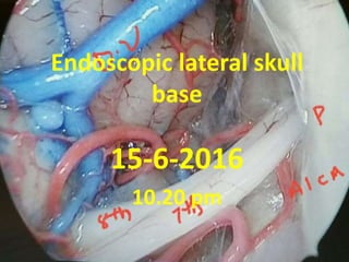 Endoscopic lateral skull
base
16-4-2017
11.23 pm
 