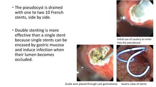 Endoscopic management in pancreatic diseases | PPTX