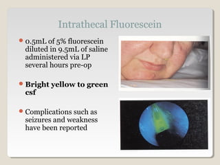 0.5mL of 5% fluorescein
diluted in 9.5mL of saline
administered via LP
several hours pre-op
Bright yellow to green
csf
Complications such as
seizures and weakness
have been reported
 
