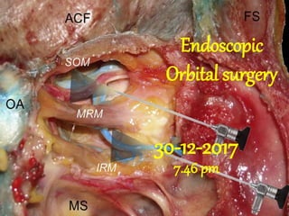 Endoscopic
Orbital surgery
30-12-2017
7.46 pm
 