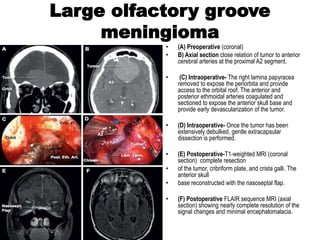 Large olfactory groove
meningioma
• (A) Preoperative (coronal)
• B) Axial section close relation of tumor to anterior
cerebral arteries at the proximal A2 segment.
• (C) Intraoperative- The right lamina papyracea
removed to expose the periorbita and provide
access to the orbital roof. The anterior and
posterior ethmoidal arteries coagulated and
sectioned to expose the anterior skull base and
provide early devascularization of the tumor.
• (D) Intraoperative- Once the tumor has been
extensively debulked, gentle extracapsular
dissection is performed.
• (E) Postoperative-T1-weighted MRI (coronal
section) complete resection
• of the tumor, cribriform plate, and crista galli. The
anterior skull
• base reconstructed with the nasoseptal flap.
• (F) Postoperative FLAIR sequence MRI (axial
section) showing nearly complete resolution of the
signal changes and minimal encephalomalacia.
 