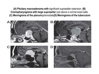(A) Pituitary macroadenoma with significant suprasellar extension. (B)
Craniopharyngioma with large suprasellar cyst above a normal sized sella.
(C) Meningioma of the planumsphenoidale(D) Meningioma of the tuberculum
sellae.
 