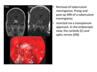 • Removal of tuberculum
meningioma. Preop and
post op MRI of a tuberculum
meningioma
• resected via a transplanum
approach. In the endoscopic
view, the carotids (C) and
optic nerves (ON)
 