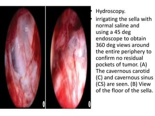 • Hydroscopy.
• irrigating the sella with
normal saline and
using a 45 deg
endoscope to obtain
360 deg views around
the entire periphery to
confirm no residual
pockets of tumor. (A)
The cavernous carotid
(C) and cavernous sinus
(CS) are seen. (B) View
of the floor of the sella.
 