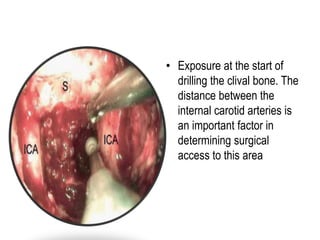 • Exposure at the start of
drilling the clival bone. The
distance between the
internal carotid arteries is
an important factor in
determining surgical
access to this area
 