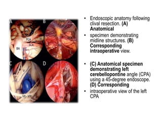 • Endoscopic anatomy following
clival resection. (A)
Anatomical
• specimen demonstrating
midline structures. (B)
Corresponding
intraoperative view.
• (C) Anatomical specimen
demonstrating left
cerebellopontine angle (CPA)
using a 45-degree endoscope.
(D) Corresponding
• intraoperative view of the left
CPA
 