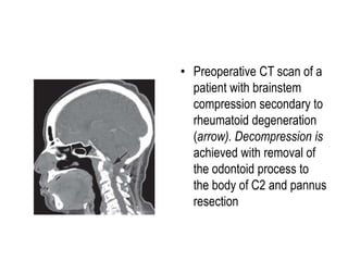 • Preoperative CT scan of a
patient with brainstem
compression secondary to
rheumatoid degeneration
(arrow). Decompression is
achieved with removal of
the odontoid process to
the body of C2 and pannus
resection
 
