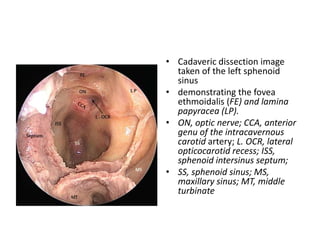 • Cadaveric dissection image
taken of the left sphenoid
sinus
• demonstrating the fovea
ethmoidalis (FE) and lamina
papyracea (LP).
• ON, optic nerve; CCA, anterior
genu of the intracavernous
carotid artery; L. OCR, lateral
opticocarotid recess; ISS,
sphenoid intersinus septum;
• SS, sphenoid sinus; MS,
maxillary sinus; MT, middle
turbinate
 