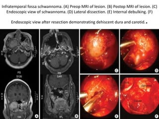 Infratemporal fossa schwannoma. (A) Preop MRI of lesion. (B) Postop MRI of lesion. (C)
Endoscopic view of schwannoma. (D) Lateral dissection. (E) Internal debulking. (F)
Endoscopic view after resection demonstrating dehiscent dura and carotid..
 
