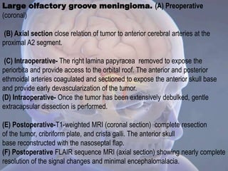 Large olfactory groove meningioma. (A) Preoperative
(coronal)
(B) Axial section close relation of tumor to anterior cerebral arteries at the
proximal A2 segment.
(C) Intraoperative- The right lamina papyracea removed to expose the
periorbita and provide access to the orbital roof. The anterior and posterior
ethmoidal arteries coagulated and sectioned to expose the anterior skull base
and provide early devascularization of the tumor.
(D) Intraoperative- Once the tumor has been extensively debulked, gentle
extracapsular dissection is performed.
(E) Postoperative-T1-weighted MRI (coronal section) complete resection
of the tumor, cribriform plate, and crista galli. The anterior skull
base reconstructed with the nasoseptal flap.
(F) Postoperative FLAIR sequence MRI (axial section) showing nearly complete
resolution of the signal changes and minimal encephalomalacia.
 