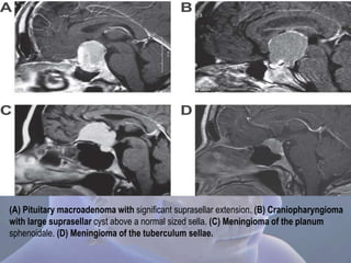 (A) Pituitary macroadenoma with significant suprasellar extension. (B) Craniopharyngioma
with large suprasellar cyst above a normal sized sella. (C) Meningioma of the planum
sphenoidale. (D) Meningioma of the tuberculum sellae.
 