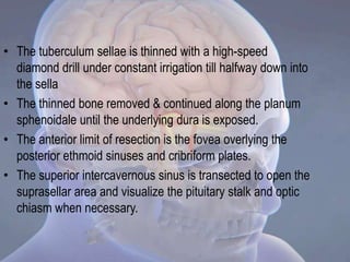 • The tuberculum sellae is thinned with a high-speed
diamond drill under constant irrigation till halfway down into
the sella
• The thinned bone removed & continued along the planum
sphenoidale until the underlying dura is exposed.
• The anterior limit of resection is the fovea overlying the
posterior ethmoid sinuses and cribriform plates.
• The superior intercavernous sinus is transected to open the
suprasellar area and visualize the pituitary stalk and optic
chiasm when necessary.
 