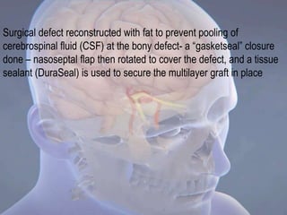 Surgical defect reconstructed with fat to prevent pooling of
cerebrospinal fluid (CSF) at the bony defect- a “gasketseal” closure
done – nasoseptal flap then rotated to cover the defect, and a tissue
sealant (DuraSeal) is used to secure the multilayer graft in place
 