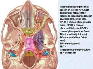 Illustration showing the skull
base in an inferior view. Each
colored area represents a
module of expanded endonasal
approach at the skull base.
CP-AF = coronal plane anterior
fossa; CP-MF = coronal
plane middle fossa; CP-PF =
coronal plane posterior fossa;
TC = transclival (pink area);
TC = transcribriform (white
area);
TO = transodontoid;
TP/T =
transplanum/transtuberculum;
TS = transsellar.
 