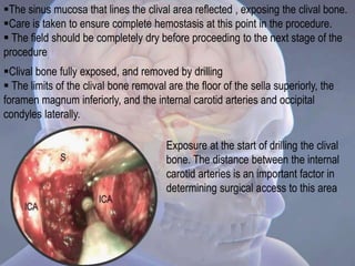 The sinus mucosa that lines the clival area reflected , exposing the clival bone.
Care is taken to ensure complete hemostasis at this point in the procedure.
 The field should be completely dry before proceeding to the next stage of the
procedure
Clival bone fully exposed, and removed by drilling
 The limits of the clival bone removal are the floor of the sella superiorly, the
foramen magnum inferiorly, and the internal carotid arteries and occipital
condyles laterally.
Exposure at the start of drilling the clival
bone. The distance between the internal
carotid arteries is an important factor in
determining surgical access to this area
 