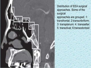 Distribution of EEA surgical
approaches. Some of the
surgical
approaches are grouped. 1:
transfrontal; 2:transcribriform;
3: transplanum; 4: transsellar;
5: transclival; 6:transodontoid
 