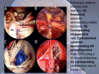 Endoscopic anatomy
following clival
resection. (A)
Anatomical
specimen
demonstrating midline
structures. (B)
Corresponding
intraoperative
view. (C) Anatomical
specimen
demonstrating left
cerebellopontine
angle (CPA) using a
45-degree endoscope.
(D) Corresponding
intraoperative view of
the left CPA.
 