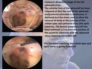 Cadaveric dissection image of the left
sphenoid sinus.
The anterior face of the sphenoid has been
removed so that the roof of the sphenoid
and posterior ethmoids is continuous. A
diamond burr has been used to allow the
removal of bone at the junction of the
orbital apex and sphenoid sinus (the optic
tubercle). The lamina papyracea (LP) has
been removed 1.5 cm from the junction of
the posterior ethmoids with the sphenoid
sinus, exposing periorbita (PO
The thin bone overlying the orbital apex and
optic nerve is gently flaked off
 