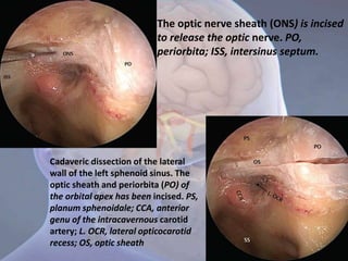 The optic nerve sheath (ONS) is incised
to release the optic nerve. PO,
periorbita; ISS, intersinus septum.
Cadaveric dissection of the lateral
wall of the left sphenoid sinus. The
optic sheath and periorbita (PO) of
the orbital apex has been incised. PS,
planum sphenoidale; CCA, anterior
genu of the intracavernous carotid
artery; L. OCR, lateral opticocarotid
recess; OS, optic sheath
 