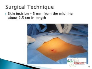 Endoscopic spinal surgery | PPTX