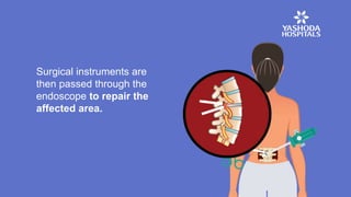 Surgical instruments are
then passed through the
endoscope to repair the
affected area.
 