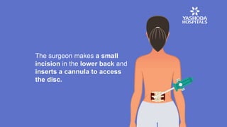 The surgeon makes a small
incision in the lower back and
inserts a cannula to access
the disc.
 