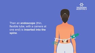 Then an endoscope (thin,
flexible tube, with a camera at
one end) is inserted into the
spine.
 