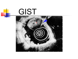 Gist Microscope Endoscopic ultrasonographi | PPT