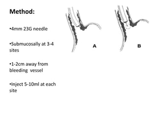 Method:

•4mm 23G needle

•Submucosally at 3-4
sites

•1-2cm away from
bleeding vessel

•Inject 5-10ml at each
site
 