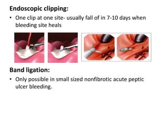 Endoscopic clipping:
• One clip at one site- usually fall of in 7-10 days when
  bleeding site heals




Band ligation:
• Only possible in small sized nonfibrotic acute peptic
  ulcer bleeding.
 