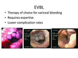 EVBL
• Therapy of choice for variceal bleeding
• Requires expertise
• Lower complication rates
 