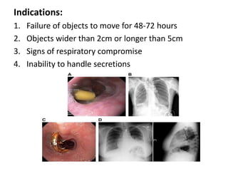 Indications:
1.   Failure of objects to move for 48-72 hours
2.   Objects wider than 2cm or longer than 5cm
3.   Signs of respiratory compromise
4.   Inability to handle secretions
 