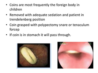 • Coins are most frequently the foreign body in
  children
• Removed with adequate sedation and patient in
  trendelenberg position
• Coin grasped with polypectomy snare or tenaculum
  forcep
• If coin is in stomach it will pass through.
 