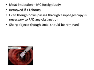 • Meat impaction – MC foreign body
• Removed if >12hours
• Even though bolus passes through esophagoscopy is
  necessary to R/O any obstruction
• Sharp objects though small should be removed
 