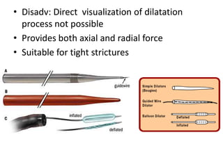 • Disadv: Direct visualization of dilatation
  process not possible
• Provides both axial and radial force
• Suitable for tight strictures
 