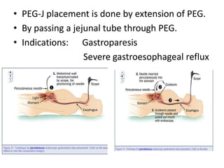 • PEG-J placement is done by extension of PEG.
• By passing a jejunal tube through PEG.
• Indications: Gastroparesis
                  Severe gastroesophageal reflux
 