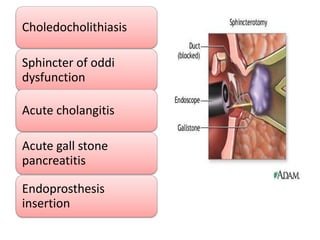 Choledocholithiasis

Sphincter of oddi
dysfunction

Acute cholangitis

Acute gall stone
pancreatitis

Endoprosthesis
insertion
 
