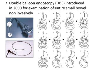 • Double balloon endoscopy (DBE) introduced
  in 2000 for examination of entire small bowel
  non invasively
 