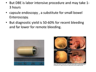 • But DBE is labor intensive procedure and may take 1-
  3 hours
• capsule endoscopy , a substitute for small bowel
  Enteroscopy.
• But diagnostic yield is 50-60% for recent bleeding
  and far lower for remote bleeding.
 