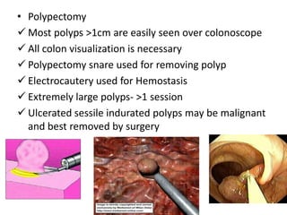 • Polypectomy
 Most polyps >1cm are easily seen over colonoscope
 All colon visualization is necessary
 Polypectomy snare used for removing polyp
 Electrocautery used for Hemostasis
 Extremely large polyps- >1 session
 Ulcerated sessile indurated polyps may be malignant
  and best removed by surgery
 