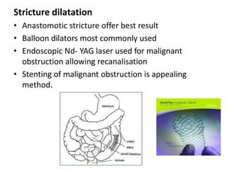 Stricture dilatation
• Anastomotic stricture offer best result
• Balloon dilators most commonly used
• Endoscopic Nd- YAG laser used for malignant
  obstruction allowing recanalisation
• Stenting of malignant obstruction is appealing
  method.
 