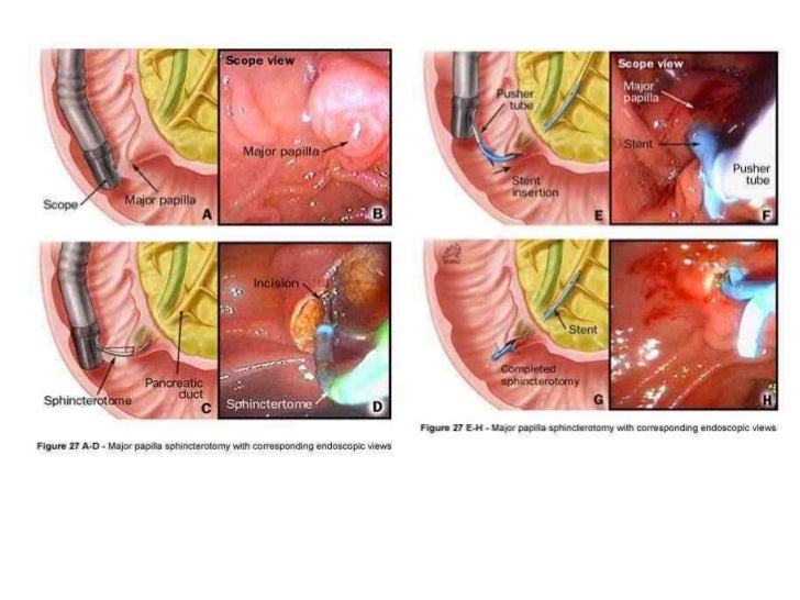 THERAPEUTIC ENDOSCOPY IN GI SURGERY