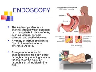 ENDOSCOPY






The endoscope also has a
channel through which surgeons
can manipulate tiny instruments,
such as forceps, surgical
scissors, and suction devices.
A variety of instruments can be
fitted to the endoscope for
different purposes.
A surgeon introduces the
endoscope into the body either
through a body opening, such as
the mouth or the anus, or
through a small incision in the
skin.

 