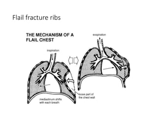 Flailing Ribs Endoscopy and thoracic trauma L2.pdfhhfyf | PDF