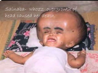 Sainaba- whozz overgrowth of
head caused her death.
 