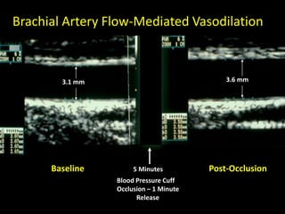 Brachial Artery Flow-Mediated Vasodilation
Baseline 5 Minutes Post-Occlusion
Blood Pressure Cuff
Occlusion – 1 Minute
Release
3.1 mm 3.6 mm
 