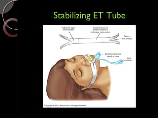 Stabilizing ET TubeStabilizing ET Tube
 